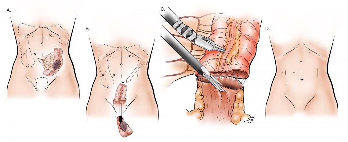 Robotic Colectomy with Transanal Extraction. The bowel is resected and removed from the anus where the bowel ends are sutured together inside the abdomen with robotic hand-sewn technique with the final incisions noted.