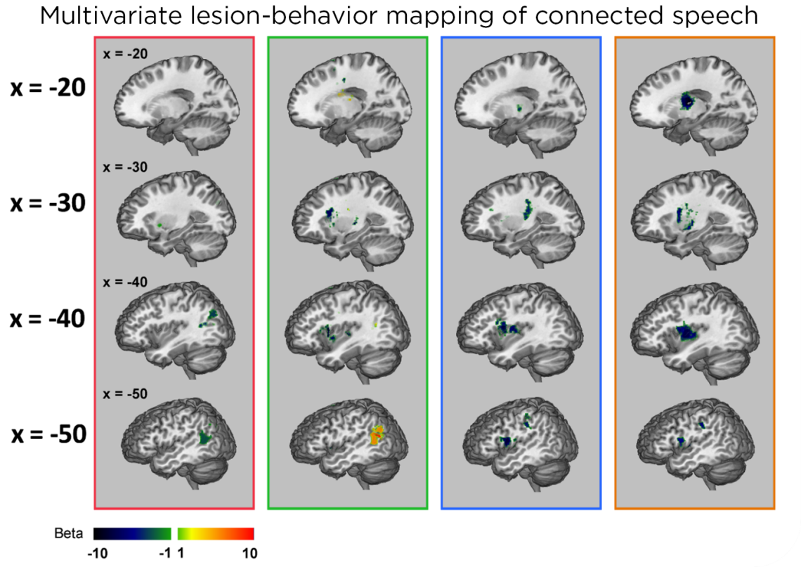 Multivariate lesion-behavior mapping of connected speech