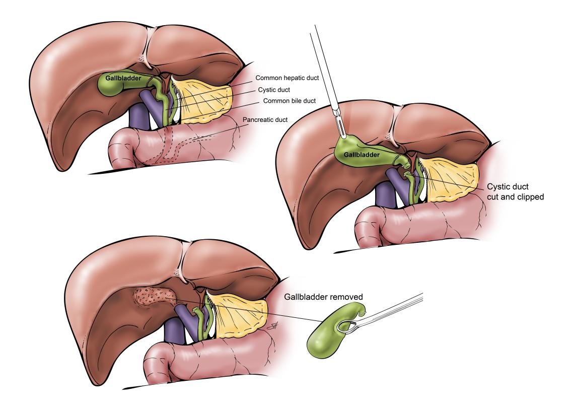 Laparoscopic Gallbladder Removal Baylor Medicine