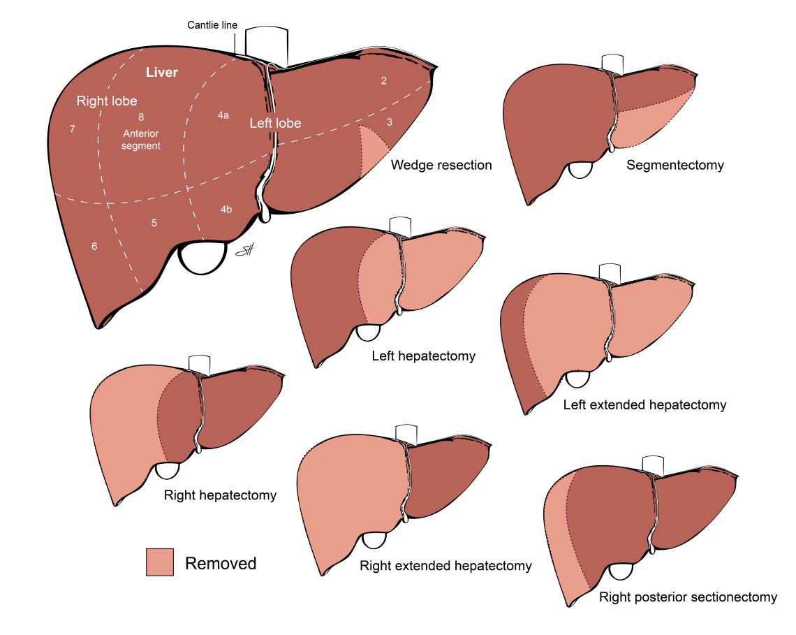 Liver Resection | Baylor Medicine