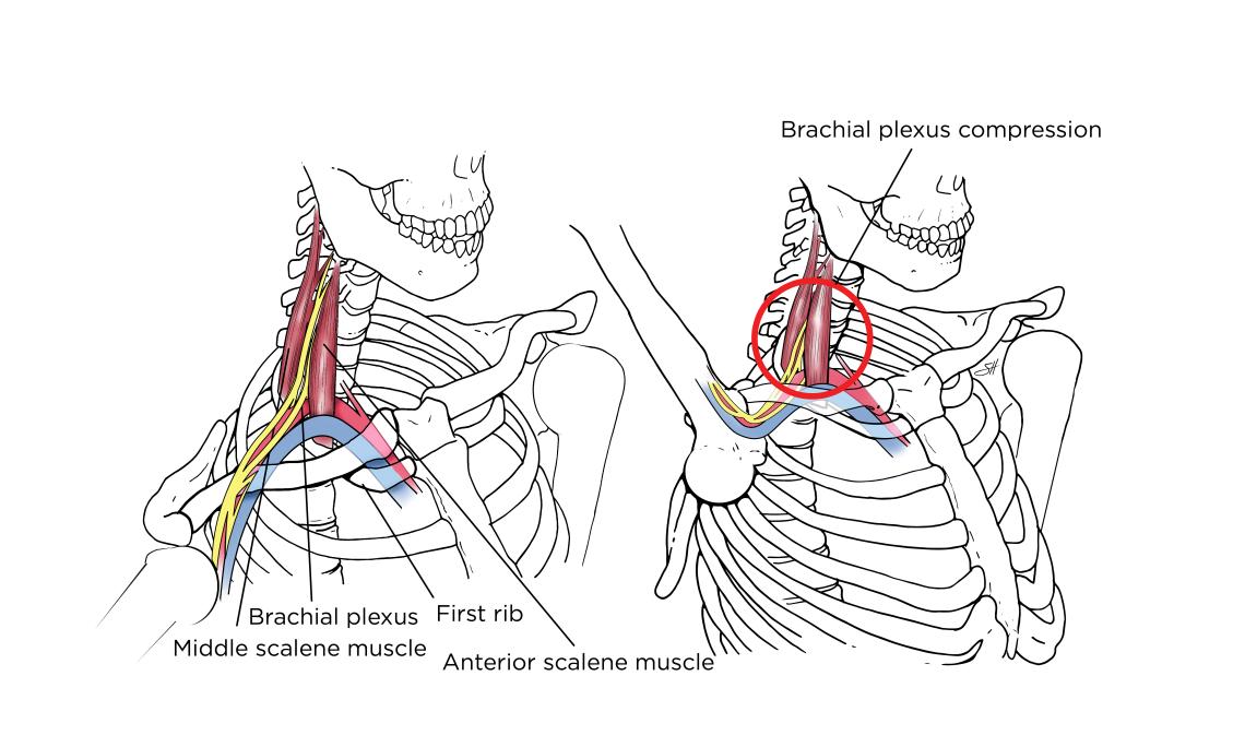 Thoracic Outlet Syndrome (TOS) - Baseline Health & Wellness