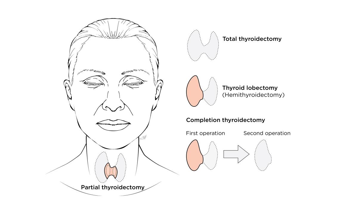 Illustration of thyroidectomy types