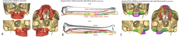 Head And Neck Reconstruction | BCM