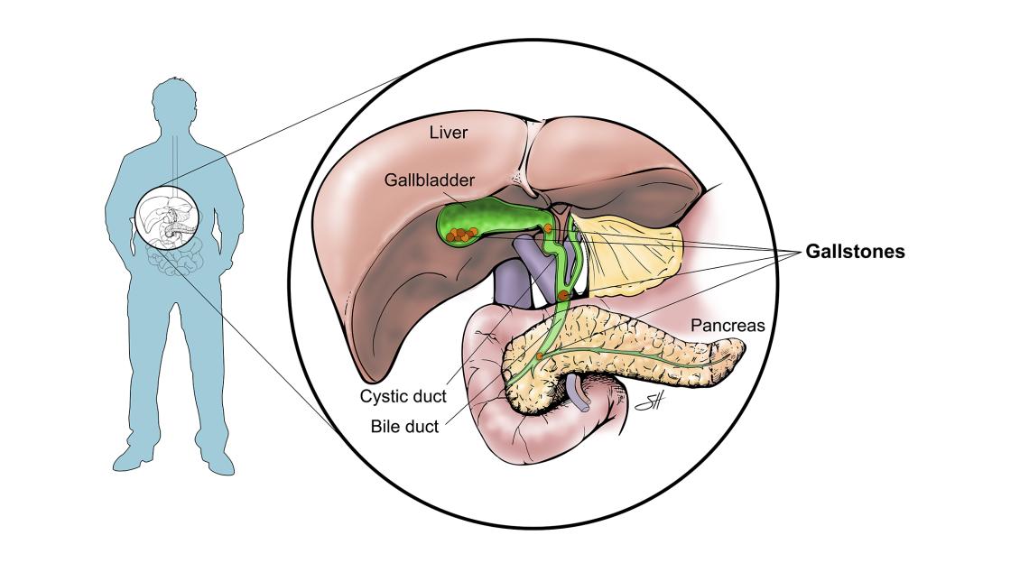 Laparoscopic Gallbladder Removal Baylor Medicine