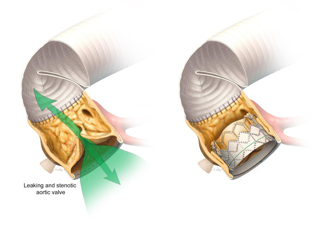 Illustration of an innovative valve-in-valve approach to address a late valvular complication in a patient with prior aortic root replacement using a porcine bioprosthetic root 