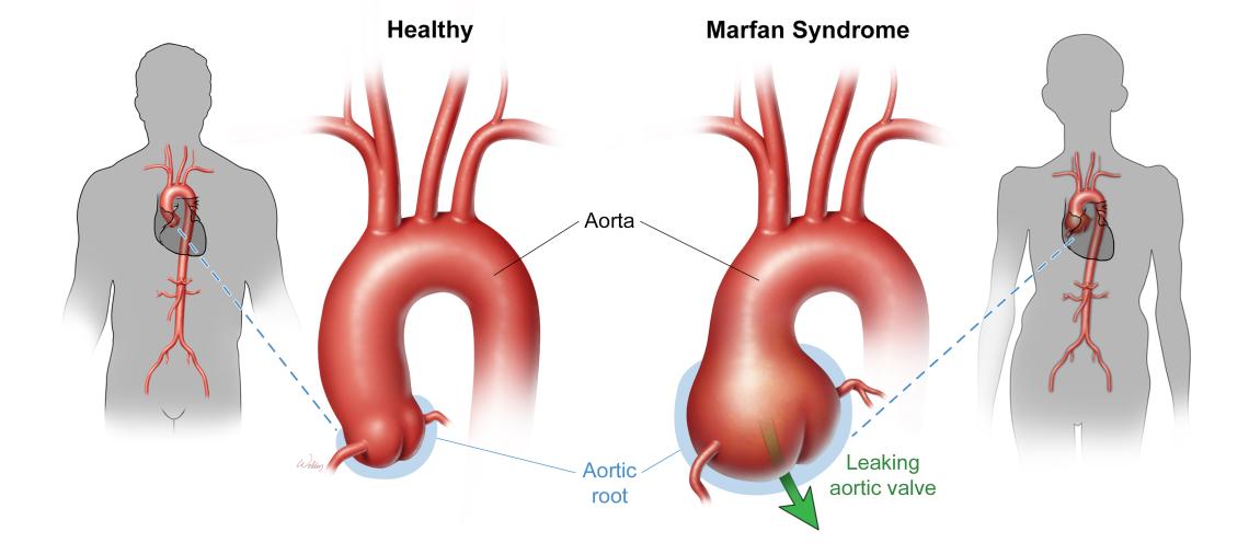 Illustration of a normal aorta root seen in a healthy individual (left) and a dilated aorta root causing aortic valve leakage in a patient with Marfan syndrome.