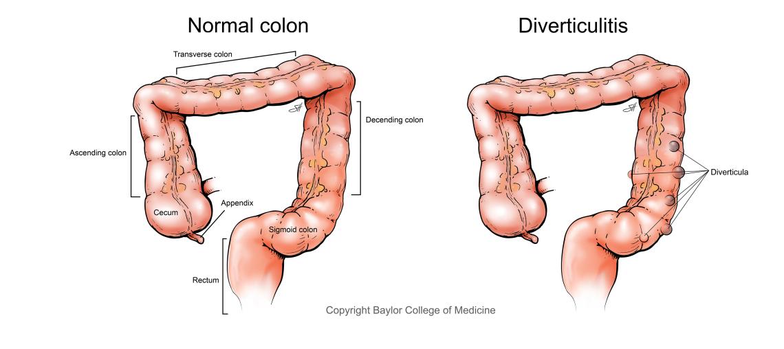 Illustration depicting a normal colon compared to a colon with diverticulitis.
