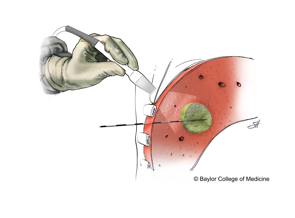 Microwave Ablation