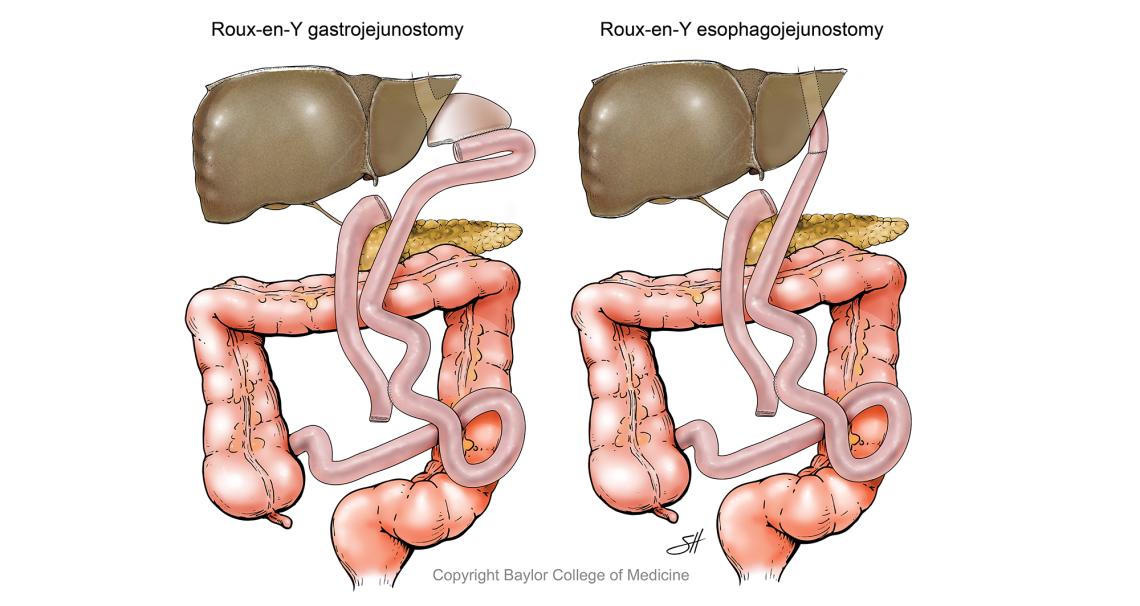 Illustratted example of the Roux-en-Ygastrojejunostomy and Roux-en-Yesophagojejunostomy procedures.