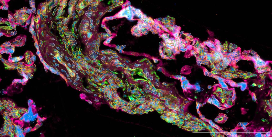 Single-cell RNA sequencing (scRNA-seq), T and B cell receptor (TCR/BCR) sequencing, spatial transcriptomics