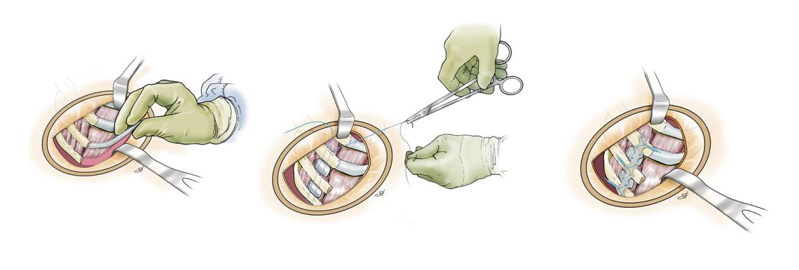 Costal cartilage reconstruction