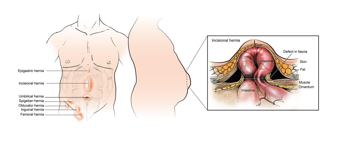 Hernia types and locations