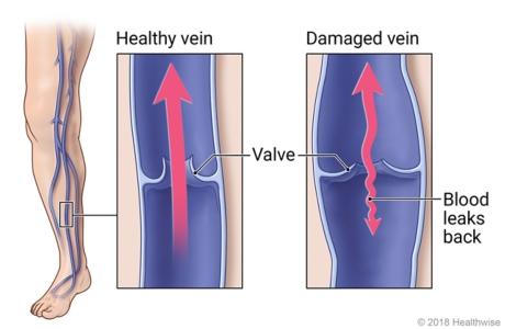 Venous Insufficiency and Venous Ulcers