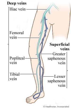 dvt in thigh