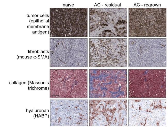 Tumor micro-environment contributions to TNBC chemoresistance: Extracellular matrix & immune therapies