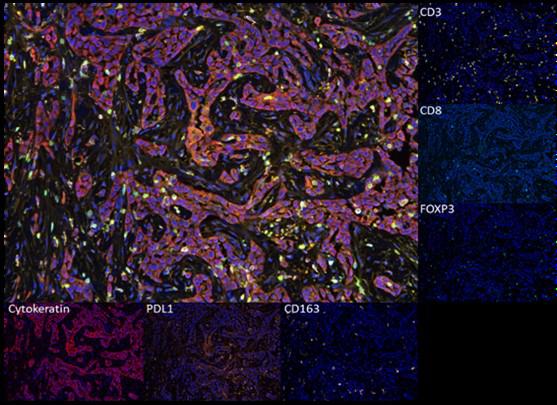 6-Color multiplex immune panel on FFPE cancer tissue.