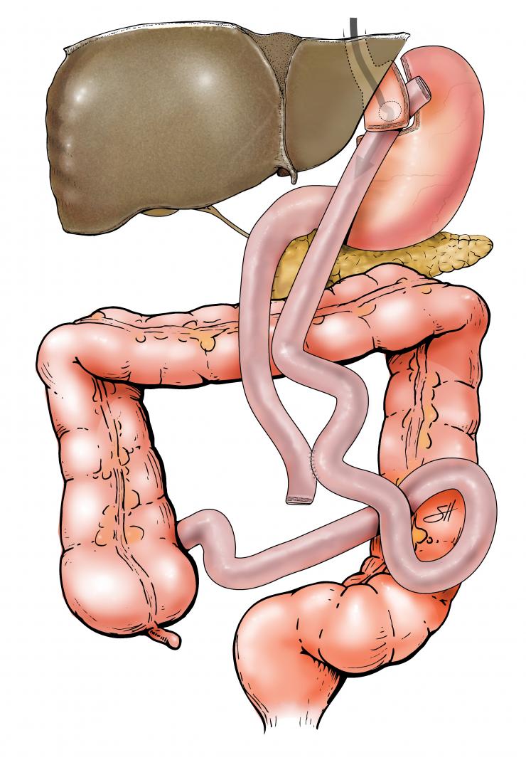 Gastric Bypass Surgery Baylor Medicine