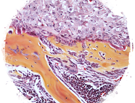 Breast cancer cells (top part) within the bone