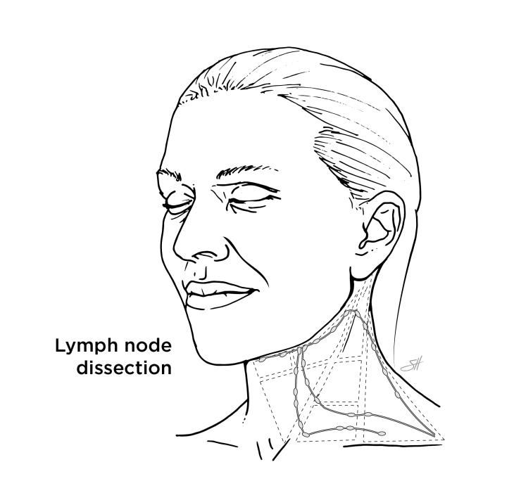Illustration of lymph nodes in the neck.
