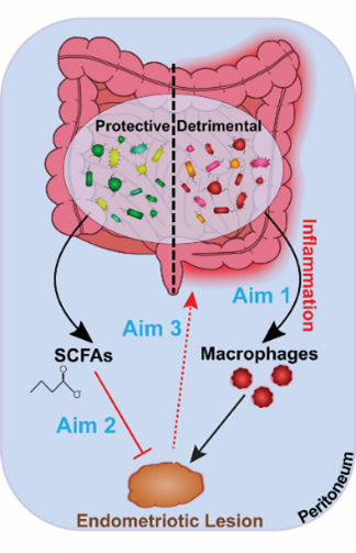 Illustration demonstrating the role of the gut microbiota and inflammation in endometriosis.