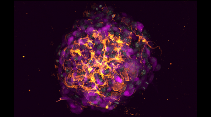 Breast Cancer Organoid Breast Cancer Organoid