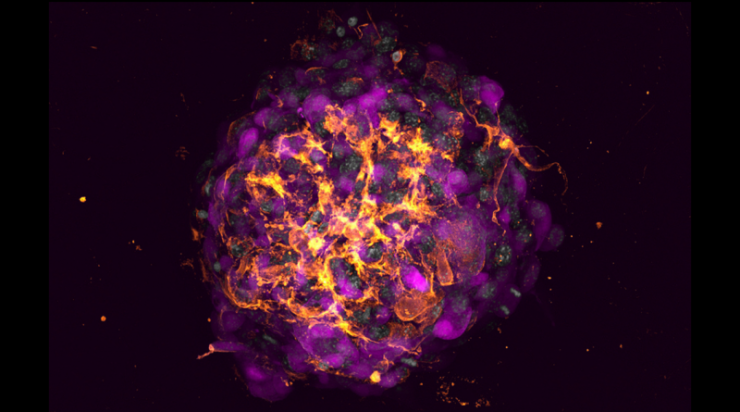 Breast Cancer Organoid