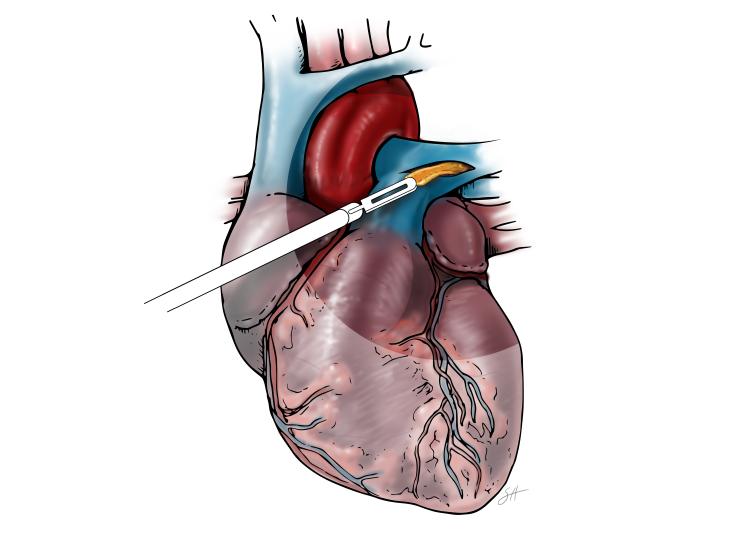 Illustration of pulmonary endarterectomy