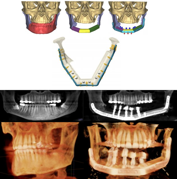 Virtual surgical plan of segmental mandibulectomy performance and fibula free flap reconstruction with same-day placement of osseointegrated dental implants. Panorex dental X-rays and 3-D reconstructed CT scan imaging of the pre-operative diseased mandible and post-operative reconstruction with dental implants and teeth in place.