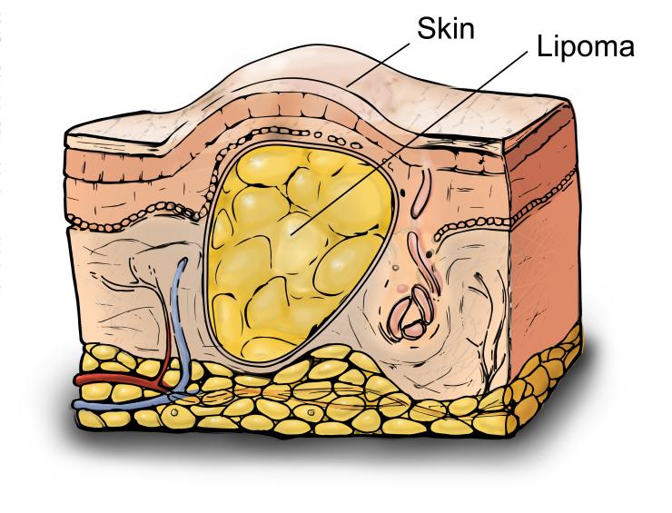 Lipoma