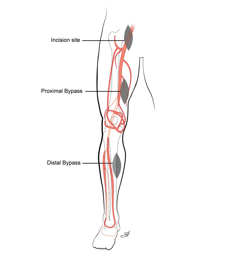 Diagram of lower extremity bypass.