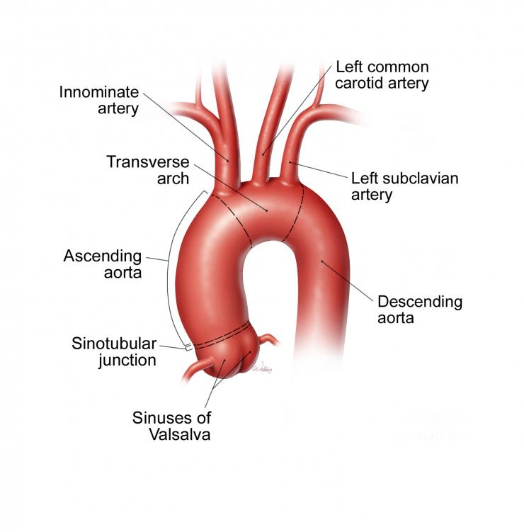 Descending and Thoracoabdominal Aortic Aneurysms and Dissections