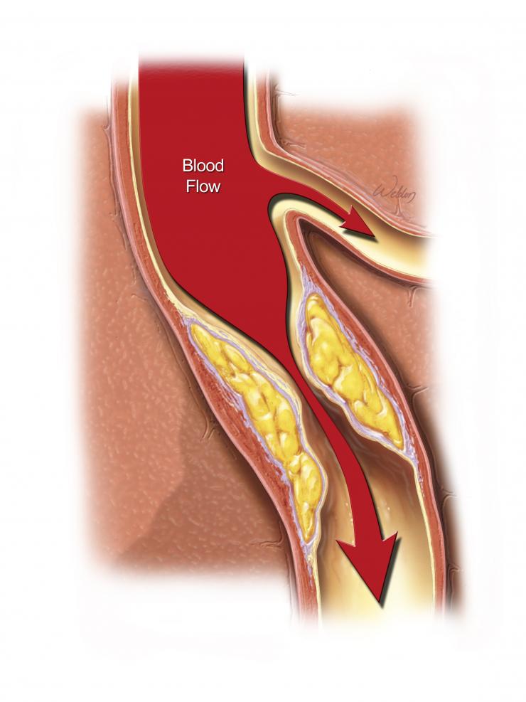 Narrowing of the coronary artery Narrowing of the coronary artery (credit: Scott Weldon)