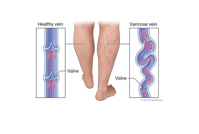 Vericose veins