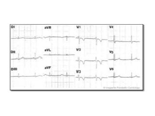 ECG taken of a patient with ARVD/C