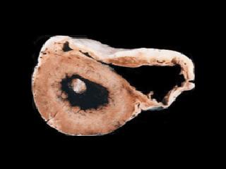 ARDV/C Heart Cross-Section Cross-section of an ARVD/C heart
