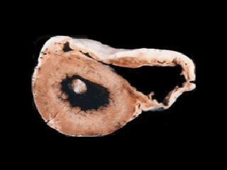 Cross-section of an ARVD/C heart