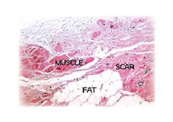 Pathology of an ARVD/C heart