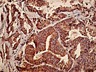 Immunohistochemistry with anti-FGFR-4 antibody showing strong staining in prostate cancer cells.
