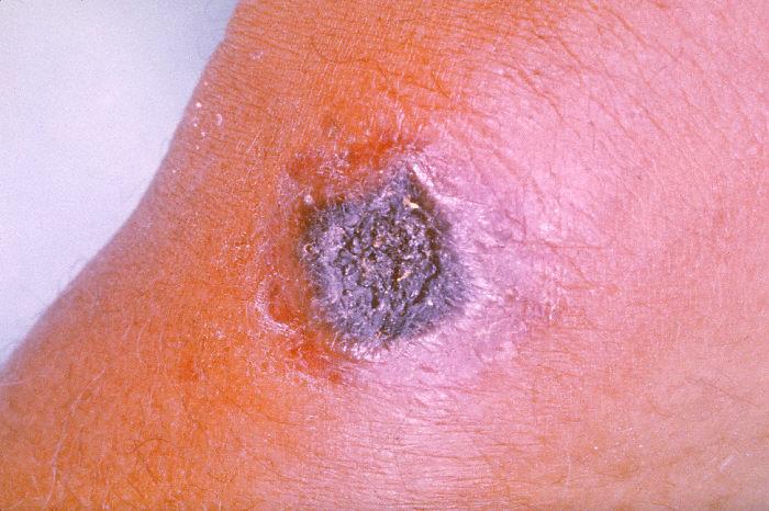 Anthrax lesion on the skin caused by Bacillus anthracis.