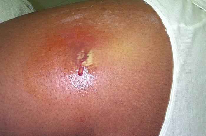 Photograph depicting a cutaneous abscess caused by methicillin-resistant Staphylococcus aureus bacteria.