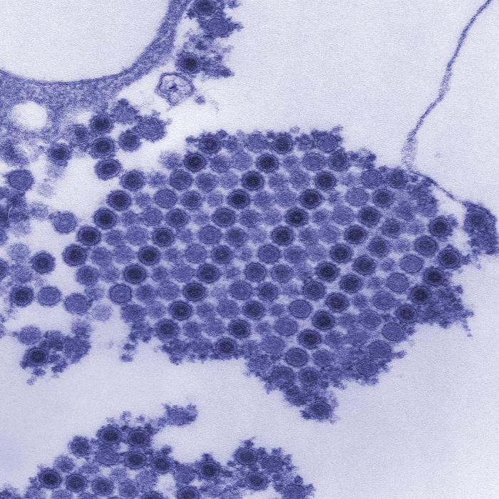 This digitally-colorized transmission electron micrograph depicts numerous Chikungunya virus particles, which are composed of a central dense core that is surrounded by a viral envelope.