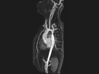 Coarctation of the Aorta