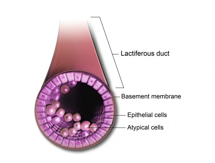Ductal Carcimoma In Situ is an early stage of cancer that is contained in the lactiferous or lobar ducts in the breast.