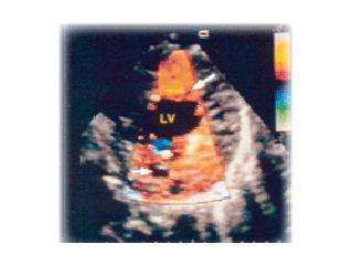 Echocardiogram of an LVNC heart