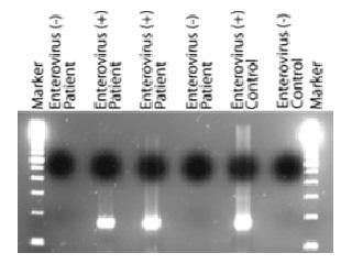 PCR amplification of enterovirus