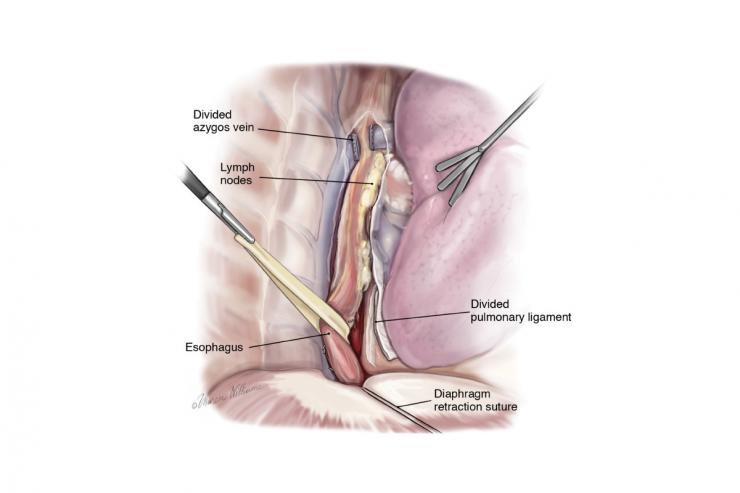 Esophagectomy procedure - courtesy McGraw-Hill