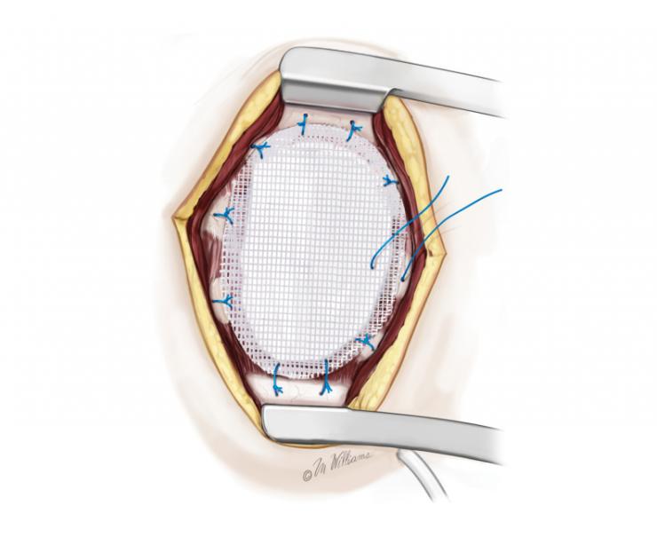 Chest Wall reconstruction.  Image copyright McGraw-Hill Company