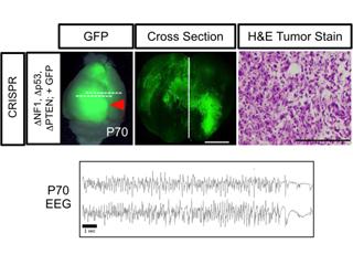 Gliogenesis and Malignant Glioma needs caption