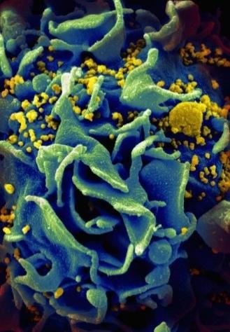 Scanning electromicrograph of an HIV-infected T cell.