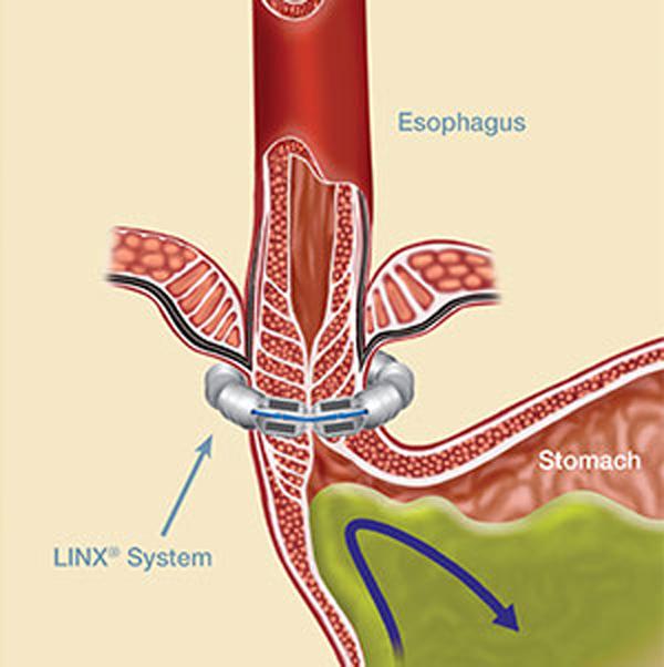 The LINX® System is designed to keep the weak LES closed to prevent reflux.